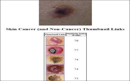 Skin Lesion Image Comparison - 谷歌插件